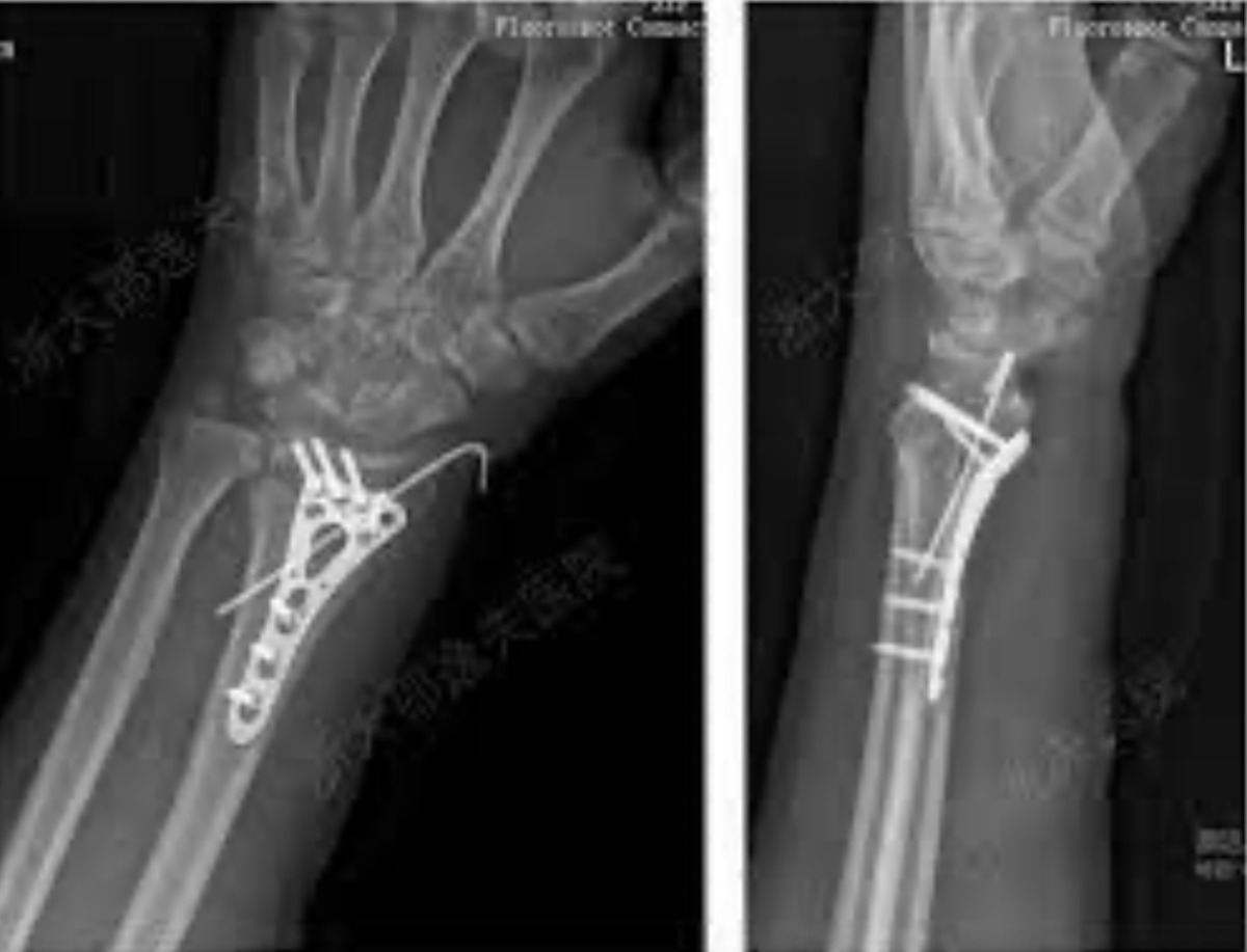 This is an X-ray photo of the new technology of bone glue.
Photo Credit: Pandaily